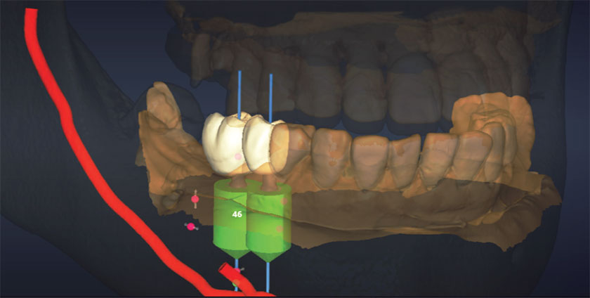 Introduction to Guided Implant Surgery