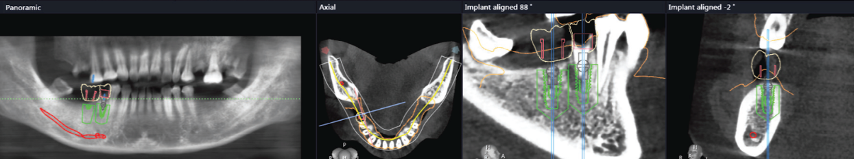 Introduction to Guided Implant Surgery