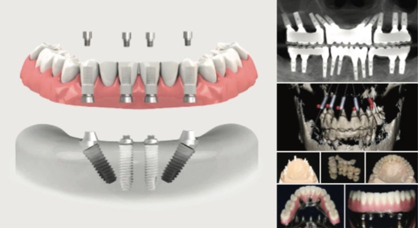 Implant Therapy in the Complex or Full-Arch: Gaining Confidence Beyond the 3-Unit Bridge (Southern California Location)